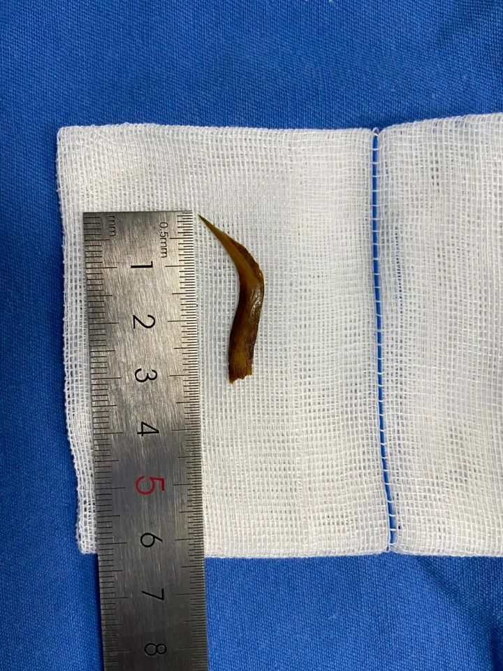 因为一根鱼刺,73岁老伯先后经历开颅,开腹两次大手术