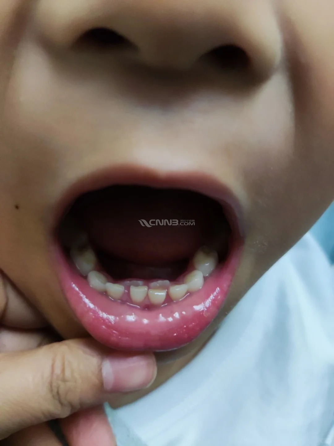 五岁半不到的男生开始换牙了_1_阿南阿南_来自小红书网页版 (2)_看图王.jpg.jpg